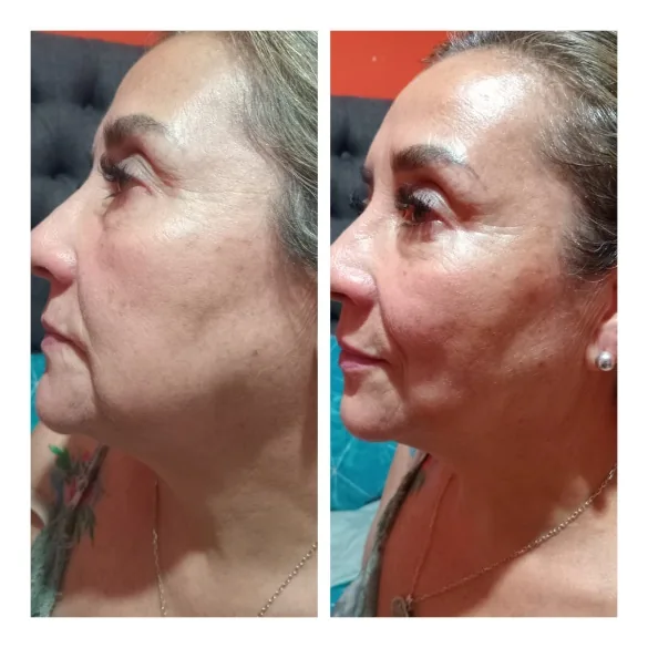Antes y después de rejuvenecimiento facial en óvalo y cuello en Bella Afrodita, Chillán