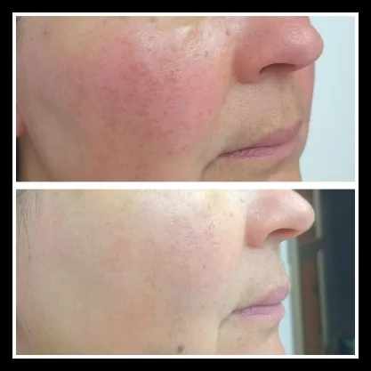 Antes y después de tratamiento descongestionante y de nutrición facial en Bella Afrodita, Chillán